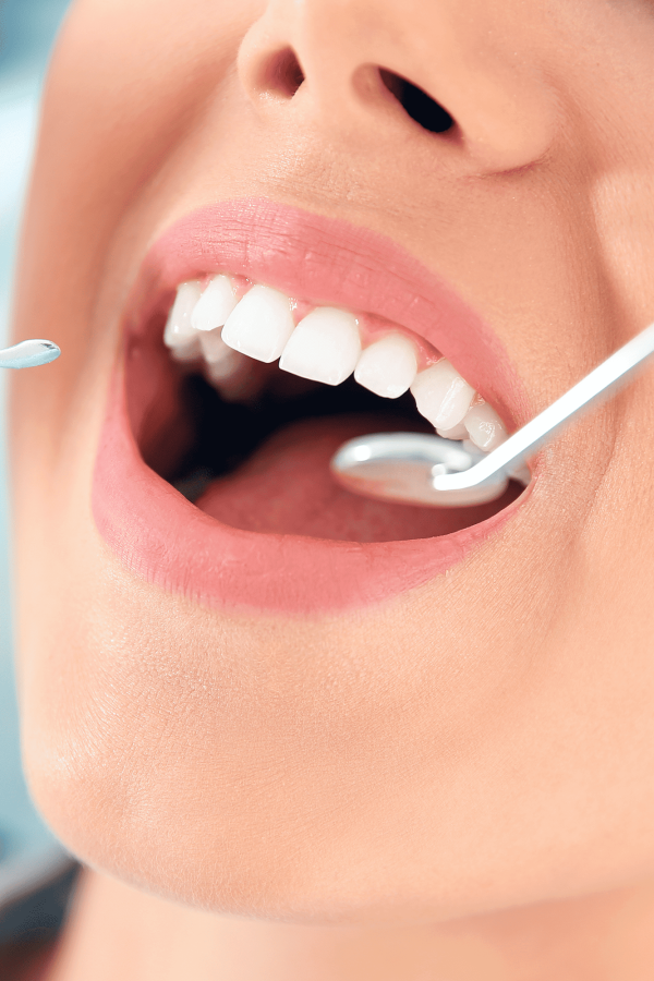 Professional Teeth Whitening Buffalo NY